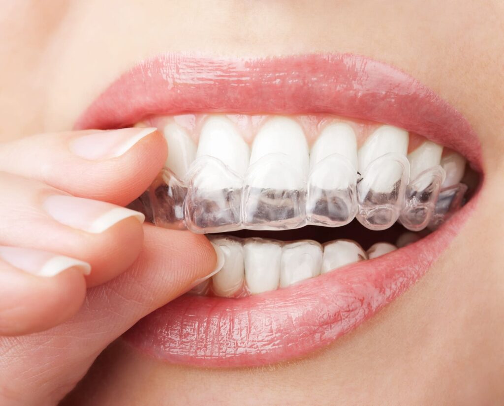 invisalign in Elmhurst IL