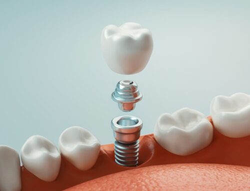 Dental Implants: Your Journey to a Restored Smile